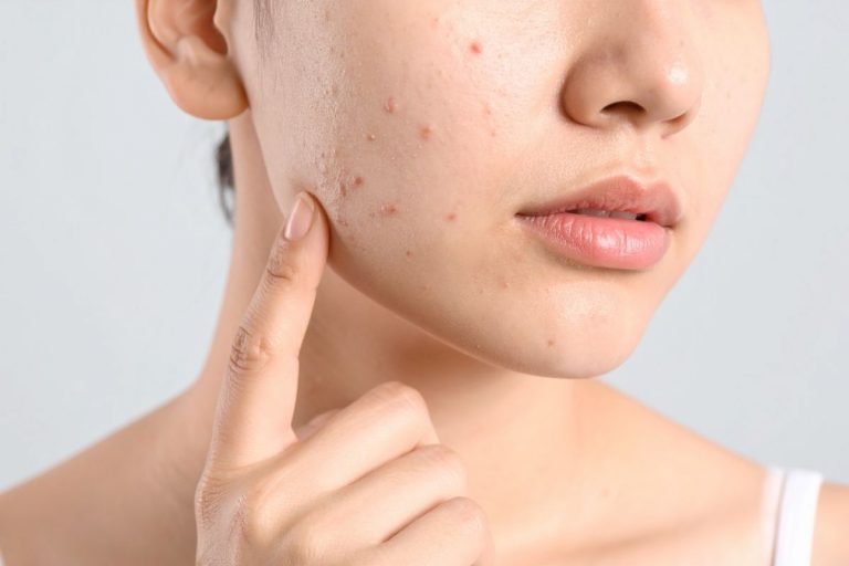 The Hormonal Acne Reality Check: What Actually Helps When You’re No Longer a Teenager